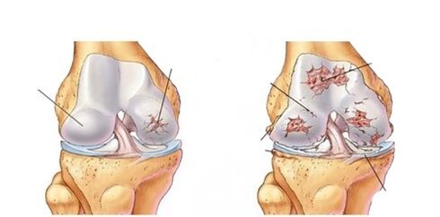 deforming knee osteoarthritis
