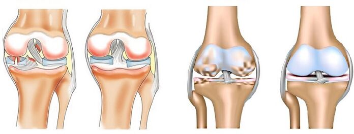 The difference between arthritis (left) and arthrosis (right) joints