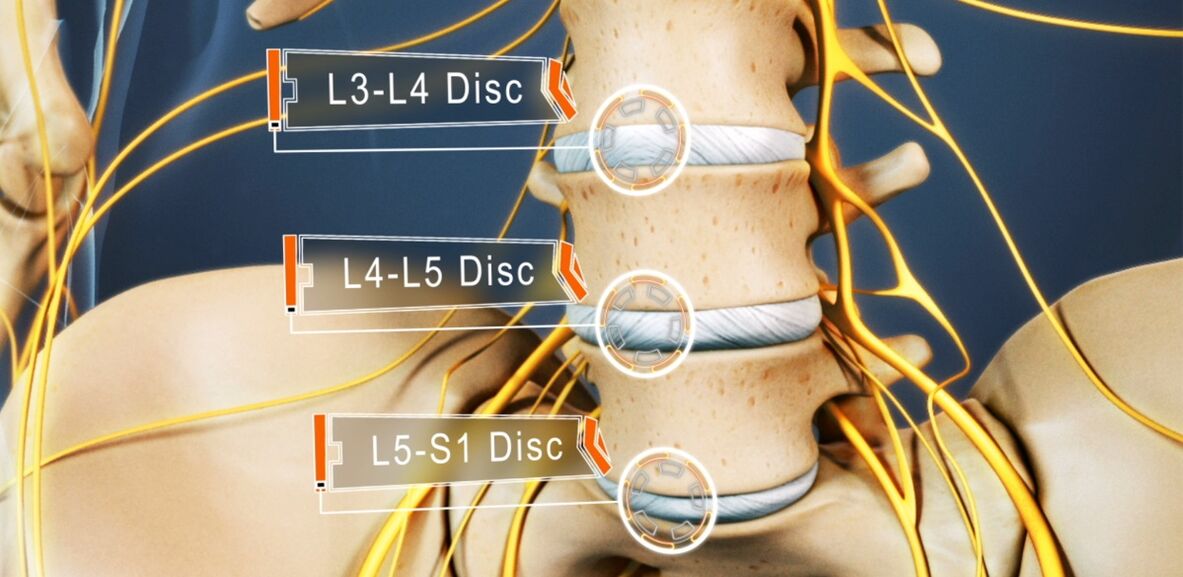 Discs of the lumbar spine, which are most often affected in osteochondrosis