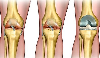 Development level of arthrosis knee joint
