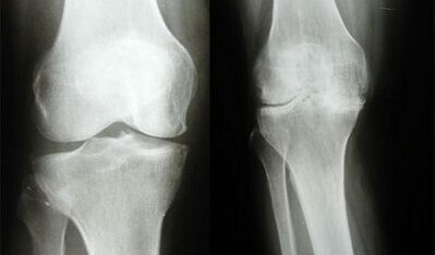 Knee diagnosis methods