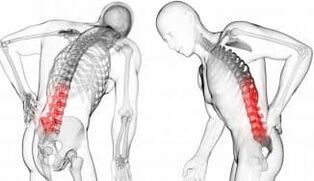 Intervertebral Hernia - Complication with osteochondrose