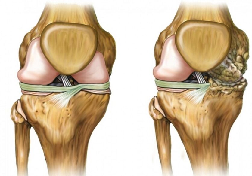 Knee arthrosis