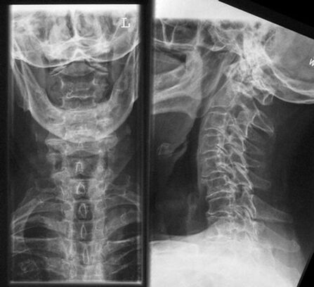 Cervical X -Ray - Method of Diagnosis of Osteochondrose