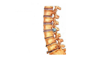 Damage to spine with cervical osteochondrose