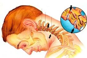 Growing nerve in spine with cervical osteochondrose