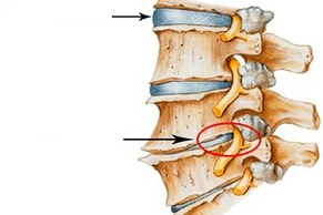 Normal and damaged spine with cervical osteochondrose