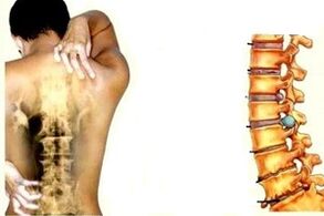 Rear parts pain different stages of cervical osteochondrose development