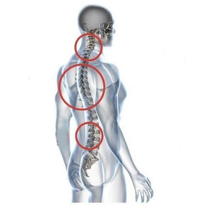 sites of osteochondrosis of the spine