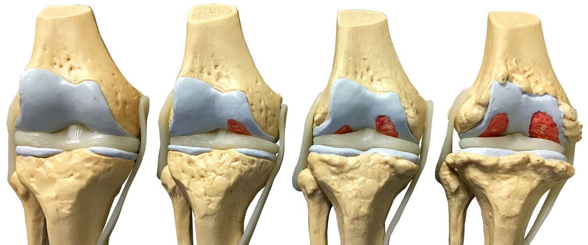 stage of arthrosis