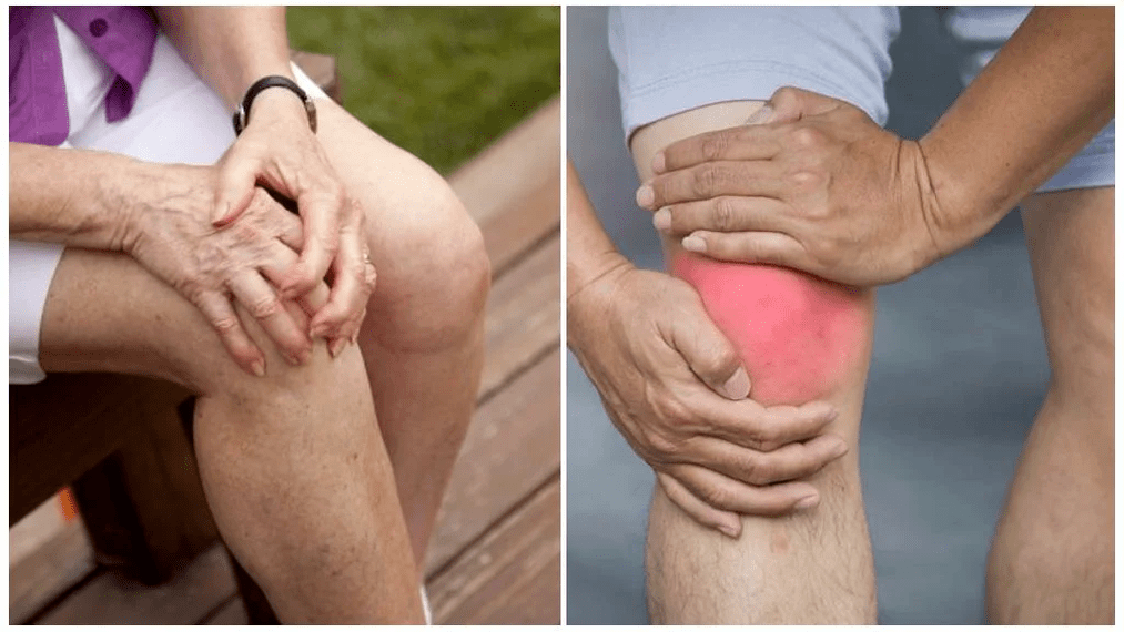treatment of arthrosis