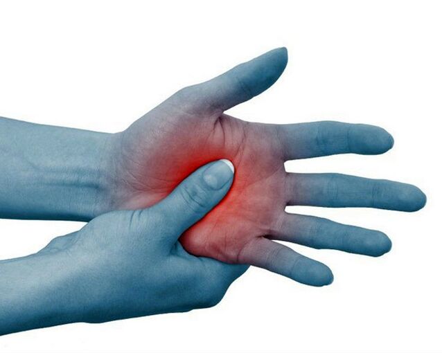 Severe pain in the joints of the fingers, which is reduced by exercise, is a typical sign of rheumatoid arthritis.